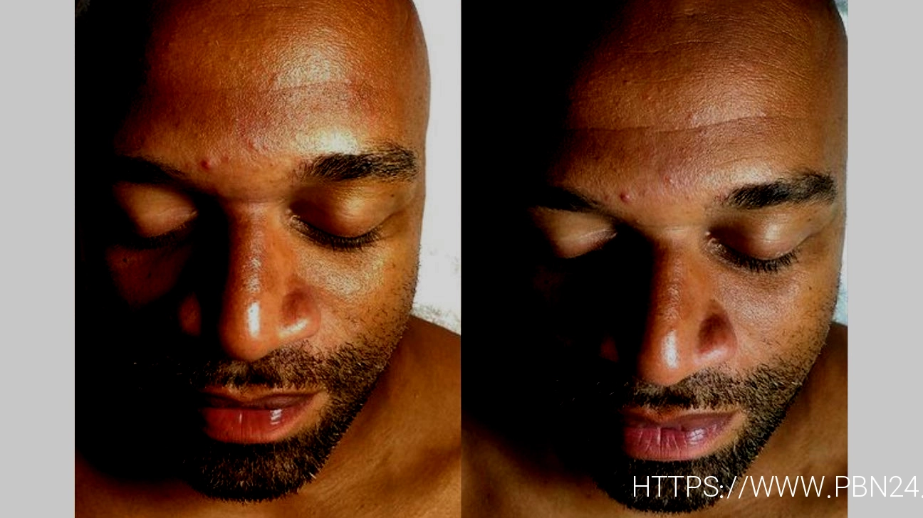 facial hypotherapy
